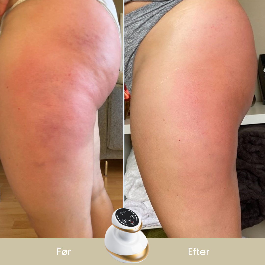 CelluSmooth™ - Anti cellulite massageapparat