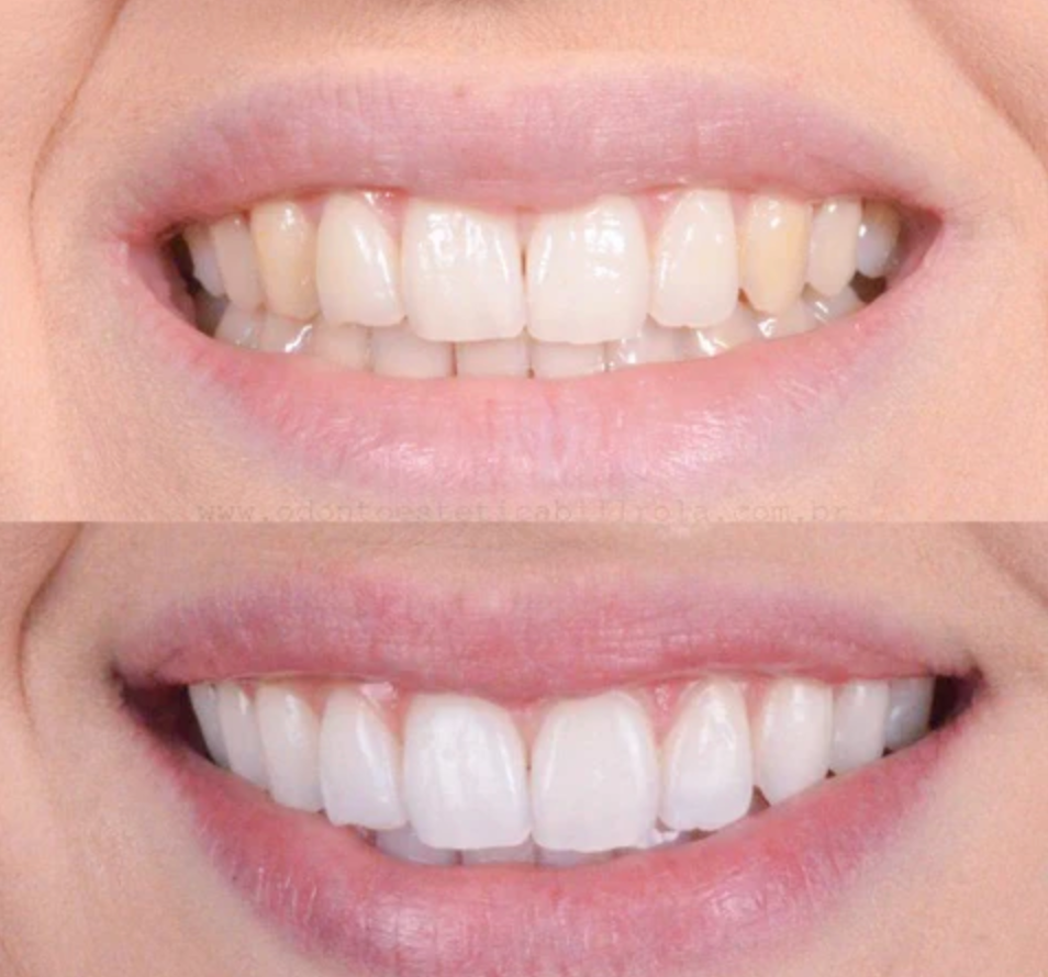 Tandblekningspenna – Kliniskt inspirerad blekning hemma