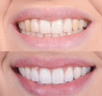 Tandblekningspenna – Kliniskt inspirerad blekning hemma