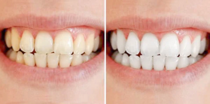 Tandblekningspenna – Kliniskt inspirerad blekning hemma