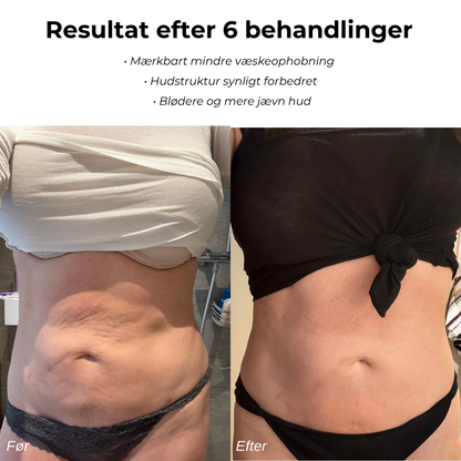 CelluSmooth™ - Anti cellulite massageapparat